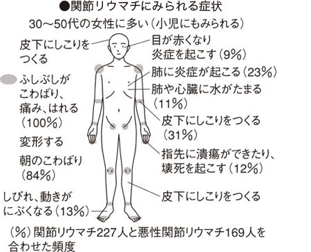 ライター症候群 リウマトイド コレクション