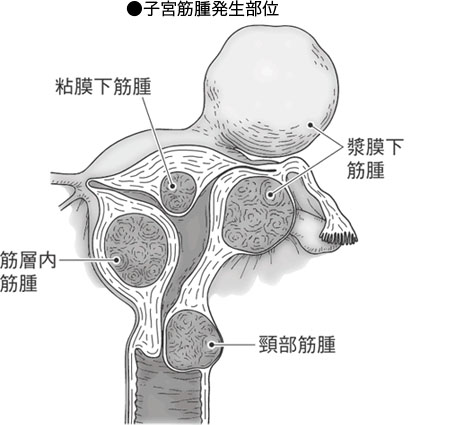 子宮筋腫の臨床 子宮筋腫